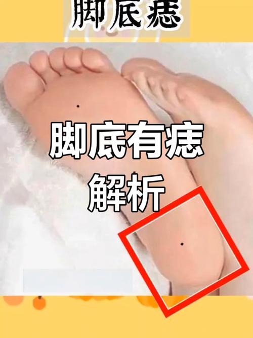 右腳底長痣好不好