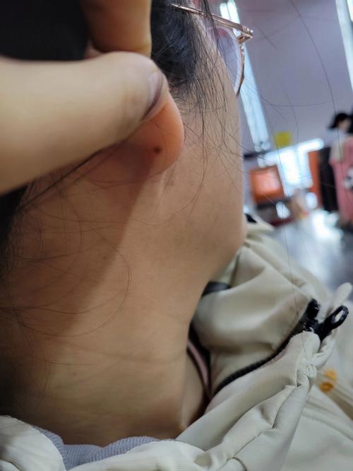 耳垂后面有痣代表什么 耳垂上長痣代表什么