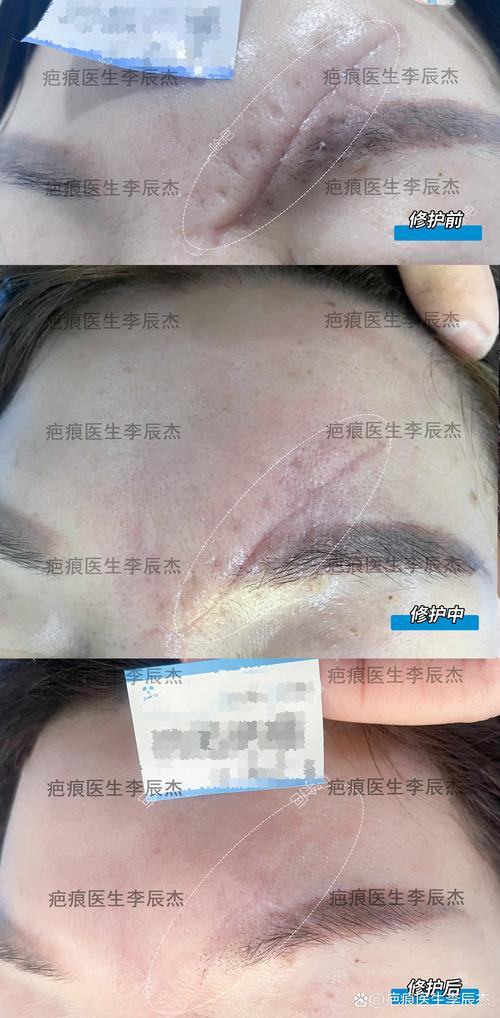 眉毛有疤影響運勢嗎