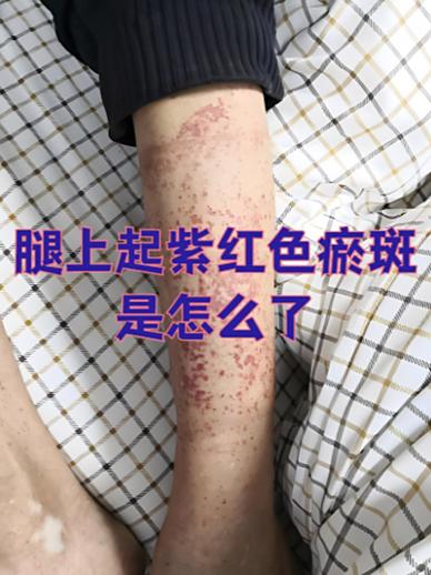 一生桃花不斷女人痣 小腿內(nèi)側(cè)有痣爛桃花纏身