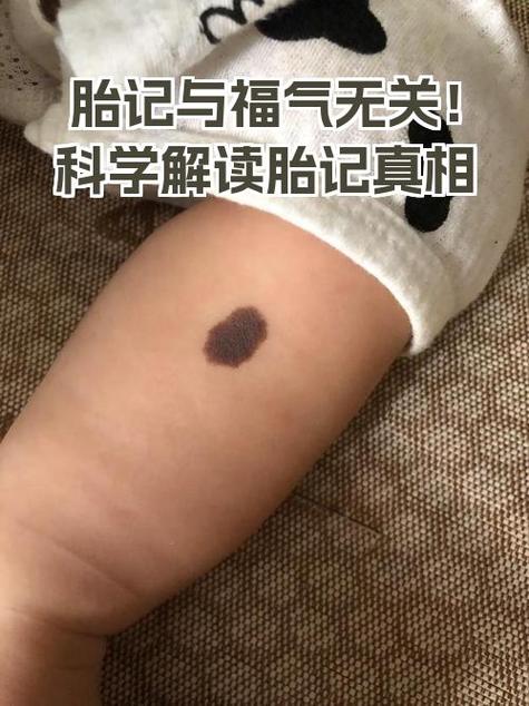 最有福氣的十處胎記 福澤深厚大富大貴