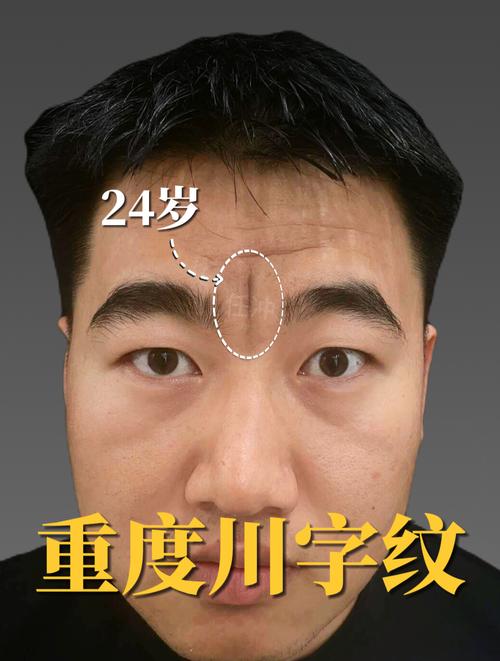 男人川字紋額頭好不好 身體安康無受病邪侵襲
