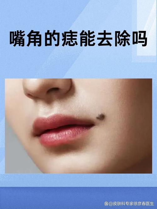上嘴角的痣可以去掉嗎 生活順心如意吉祥福報多
