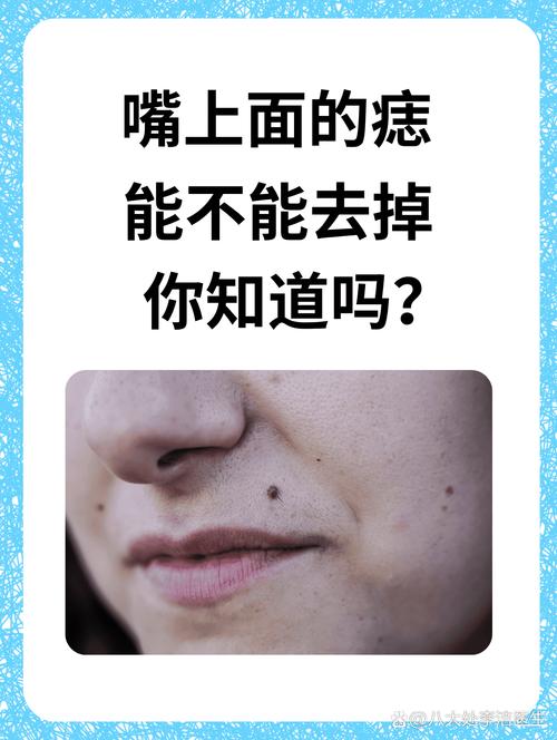 嘴唇上面的痣可以去掉嗎 貴人緣分深事業有成指日可待