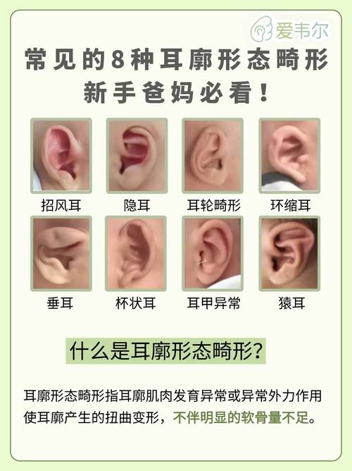 8種耳廓畸形圖片 事業必然有成一生豁達