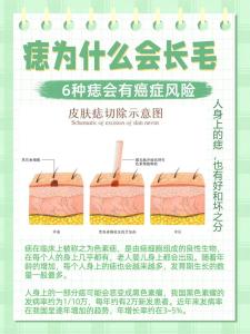 女人痣上長毛好不好 痣上長毛的寓意解析