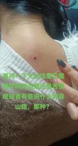 靠山痣和苦情痣的區別 苦情痣則感情波折靠山痣則天生貴相