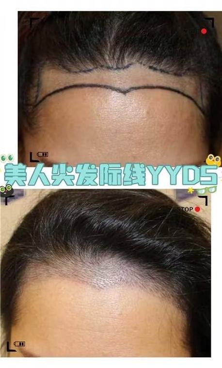 去掉美人尖影響大嗎 會不會影響運氣