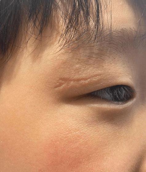 眼睛周圍有疤痕影響運勢嗎