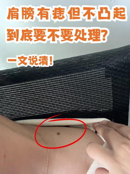 左右肩膀上有痣好不好