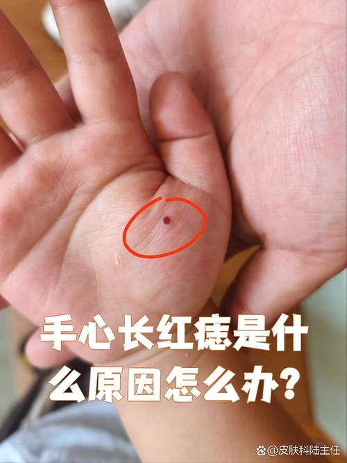 手掌邊緣上突然長出了一顆痣 手掌有紅痣代表什么