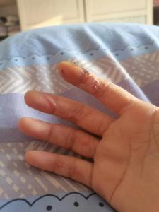 手指受傷留疤影響運勢嗎