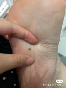 男人右腳腳底有痣是吉還是兇