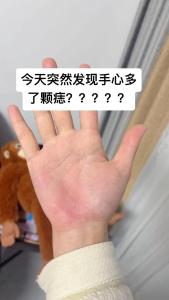 手心突然長了一顆痣 手上突然多了小黑痣