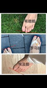 男人希臘腳命運如何