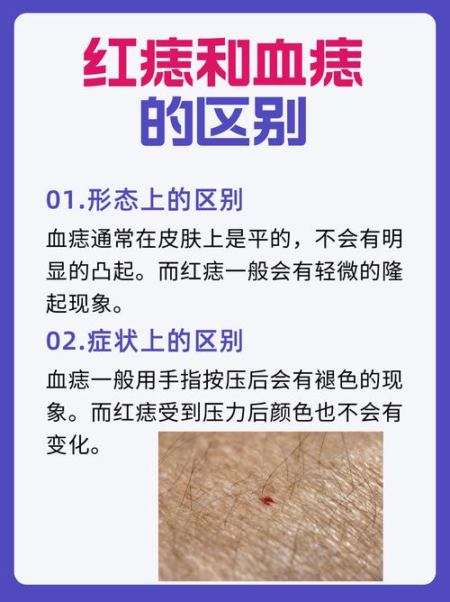 朱砂痣是長什么樣子的 朱砂痣和蚊子血痣相含義