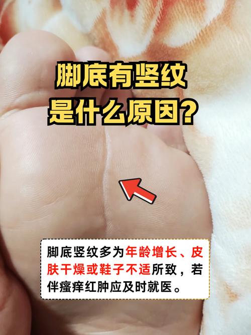 腳底有豎紋的人將來必大富大貴嗎