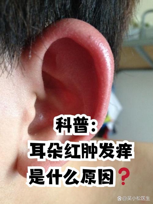 無緣無故耳朵發紅發熱
