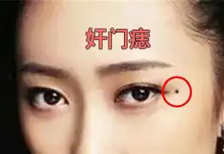 奸門有痣的女人婚姻運(yùn)勢(shì)怎么樣