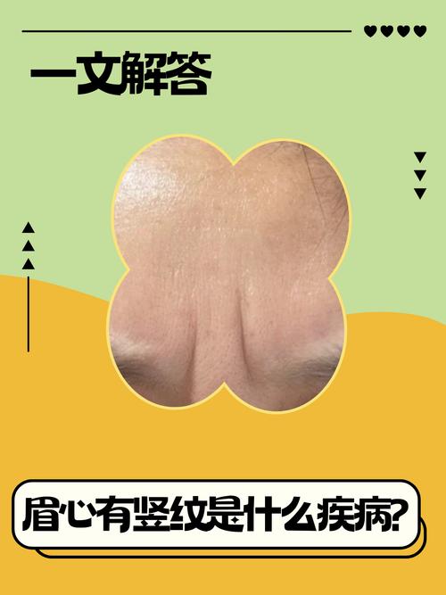 雙眉間有二道豎紋面相 兩眉之間有豎紋的女人該怎么辦