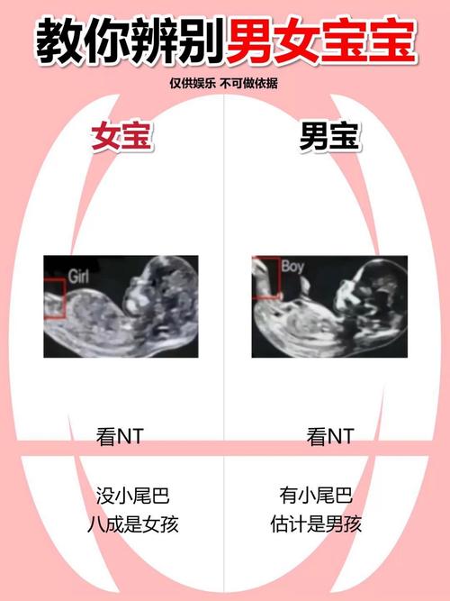 妊娠線可預示生男嗎