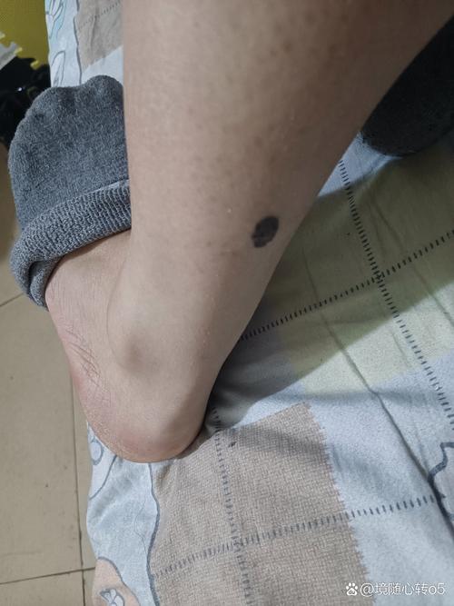 小腿肚后面長痣好不好