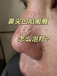 鼻頭有疤好不好 代表什么