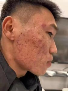 人中有痘坑面相影響什么