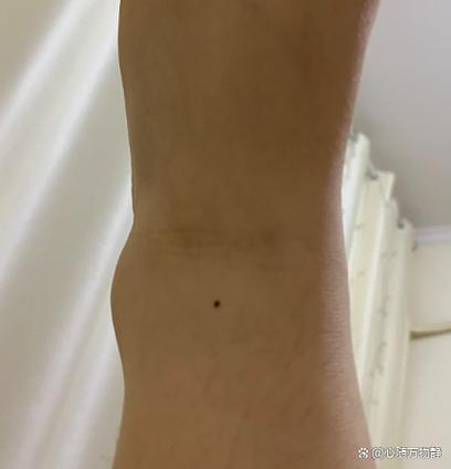 右腳踝有痣