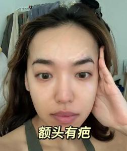 面相分析額頭有疤好不好？