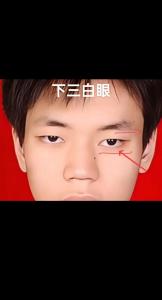 什么是三白眼 上三白眼和下三白眼各是什么