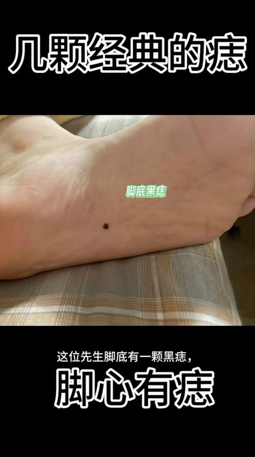 女人左腳腳底有痣是福還是禍