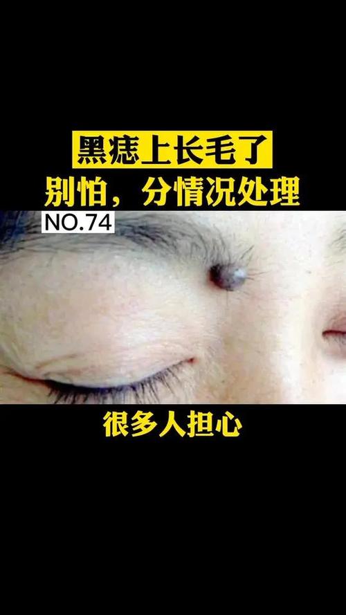 女人眼角痣上長毛是什么意思