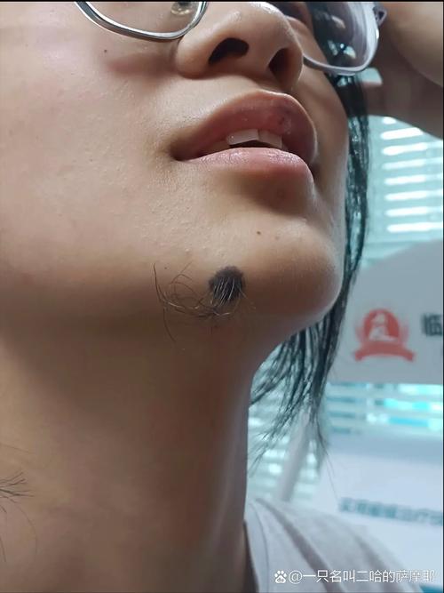 女生痣上長毛好不好