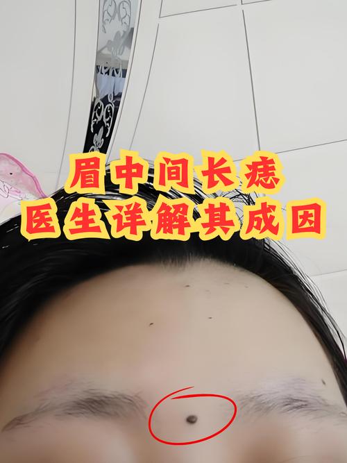 眉毛中間長痣的人命不好嗎