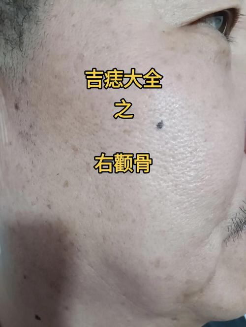 顴骨有痣的人命好嗎