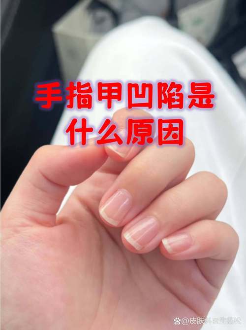 指甲凹變是提醒你注意運勢了