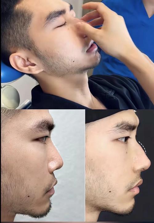 駝峰鼻的男人很難看嗎 駝峰鼻的男人很體貼并且對感情認真