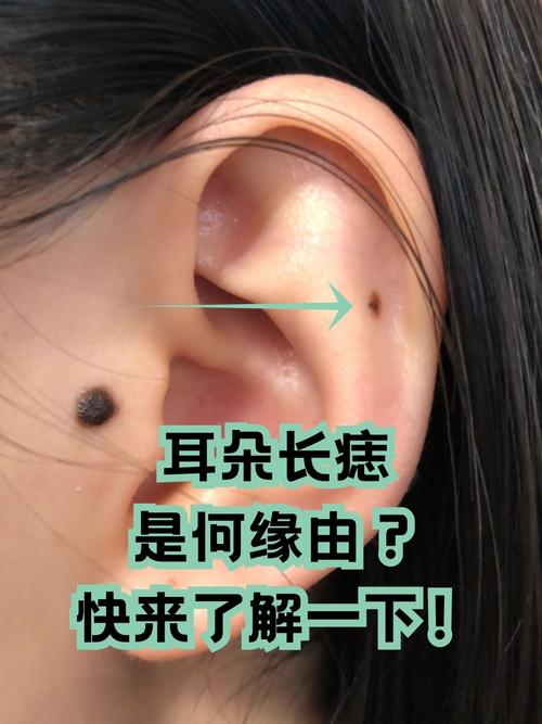 右側臉靠近耳朵有痣