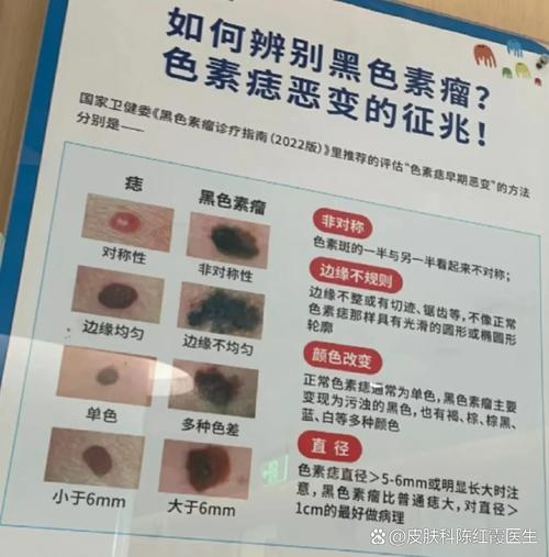小腿肚有痣