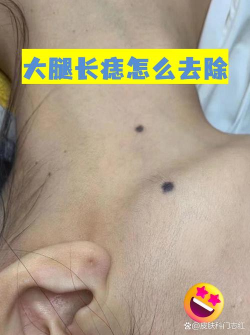 大腿中間有痣