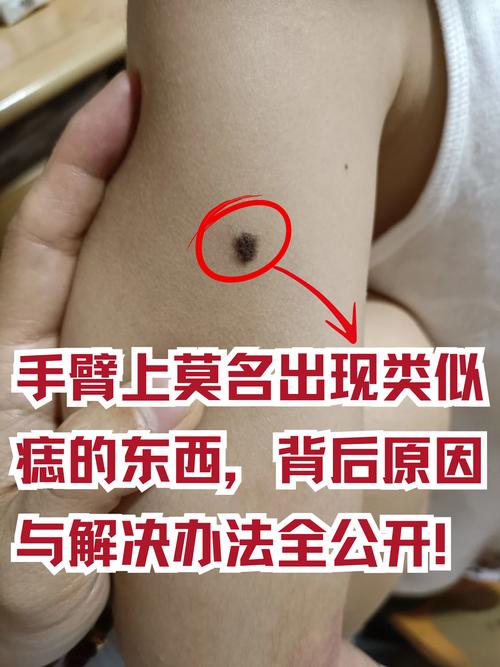 胳膊上有黑痣