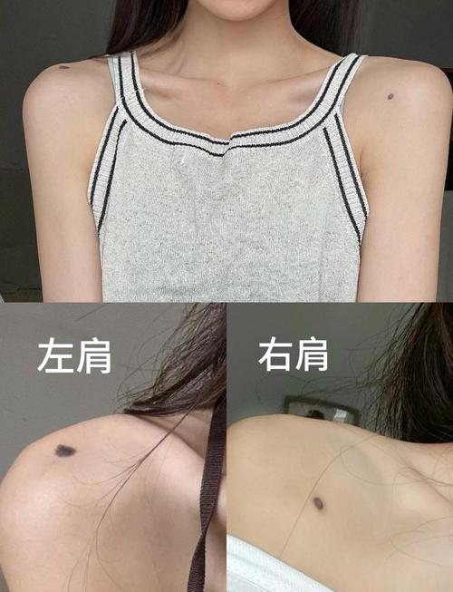 女生右肩膀有痣