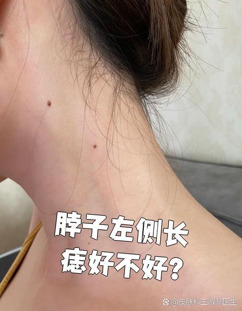 女人左邊脖子有顆大痣