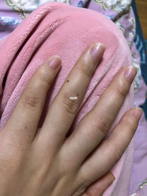 女生左手無名指長痣