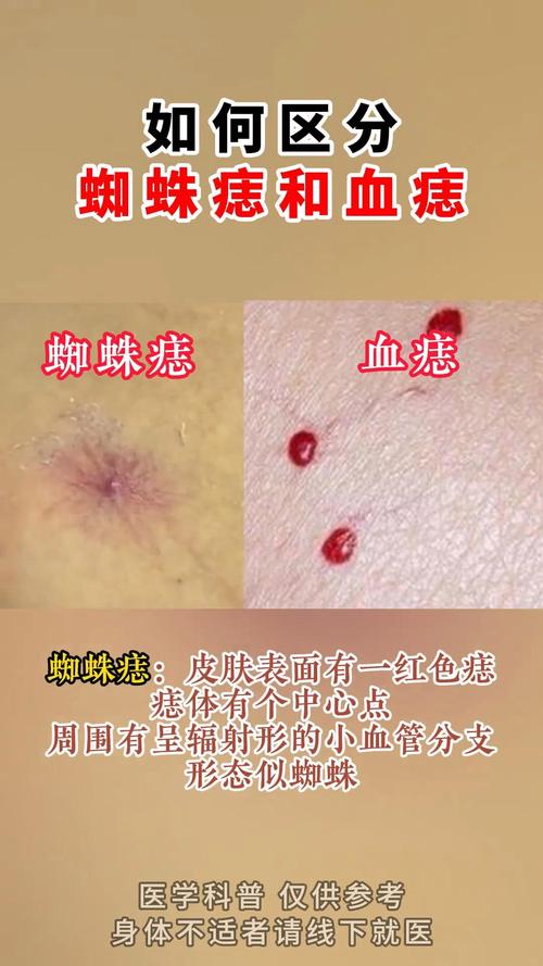 痣的位置與命運(yùn)查詢 蜘蛛痣是哪幾個(gè)位置